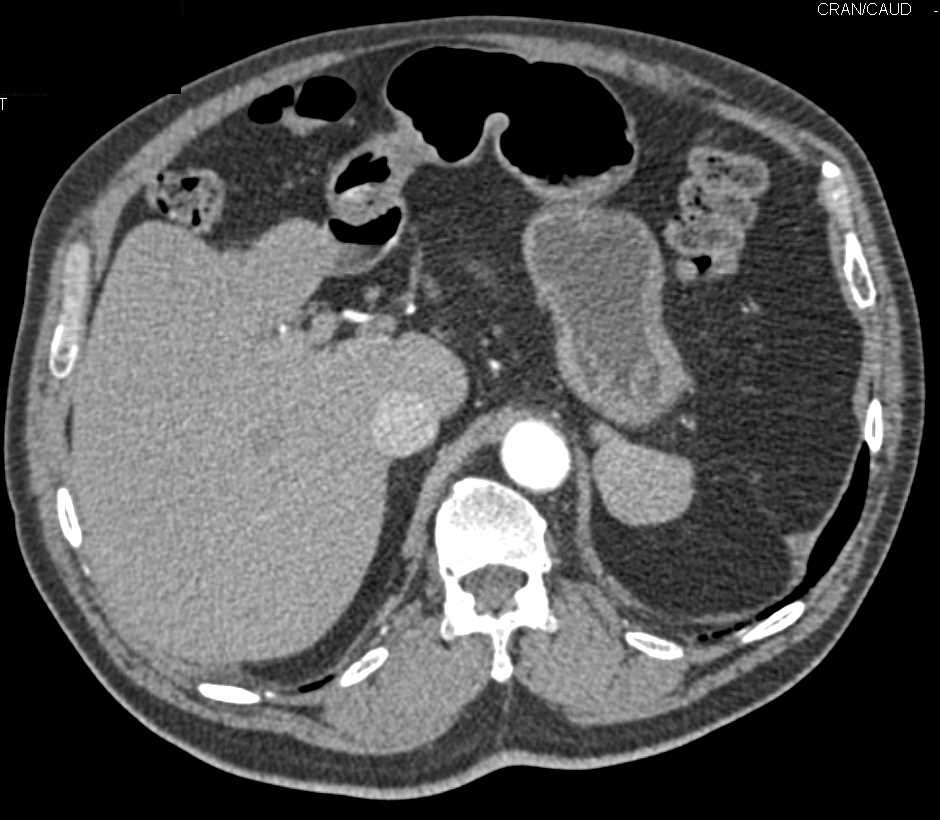 Calcified Bilateral Adrenal Glands - CTisus CT Scan