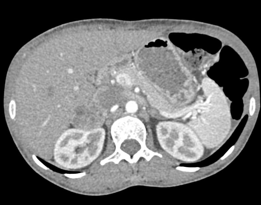 Pheochromocytoma Right Adrenal Gland - CTisus CT Scan