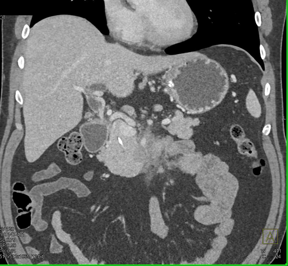 Adenocarcinoma in Uncinate Process Invades SMA - CTisus CT Scan