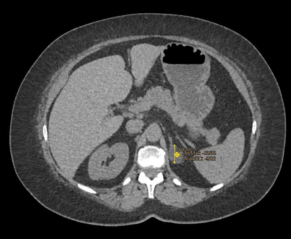 High Density Right Renal Cysts and Left Adrenal Adenoma - CTisus CT Scan