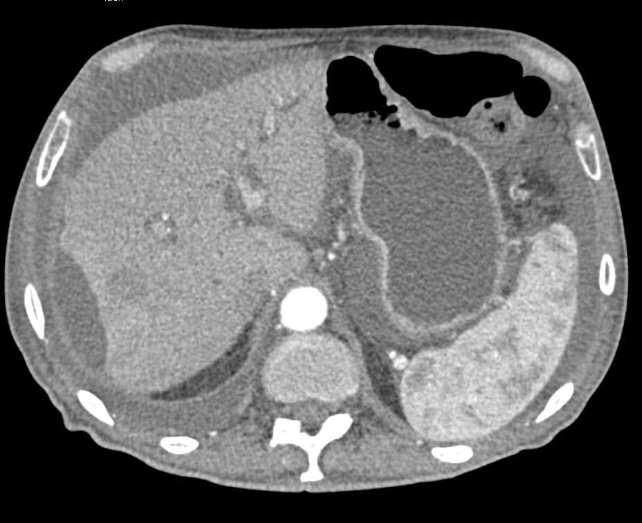 Bright Adrenals with Hypotension - CTisus CT Scan