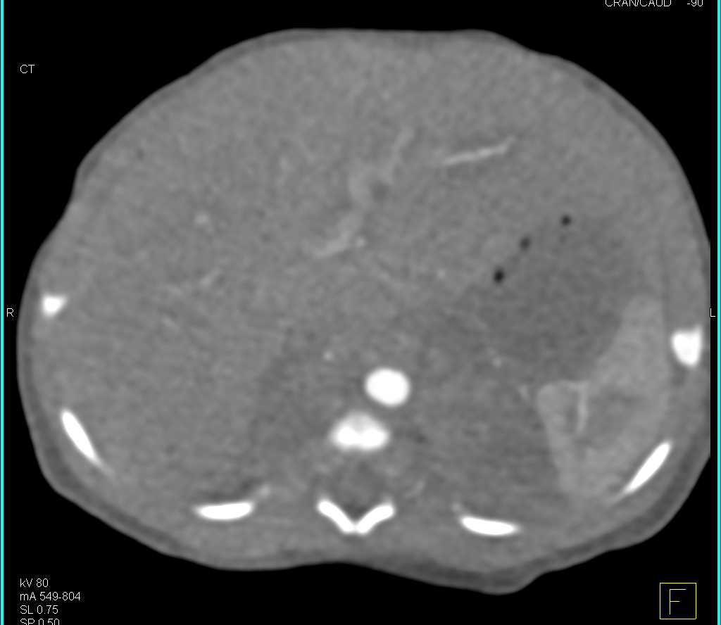 Neuroblastoma of the Adrenals - CTisus CT Scan