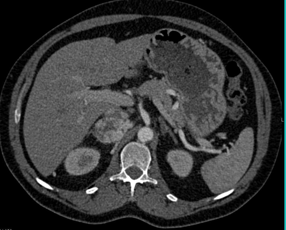 Pheochromocytoma Right Adrenal Gland - CTisus CT Scan