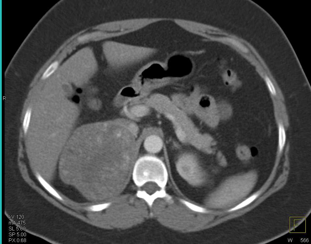 Primary Adrenal Carcinoma - CTisus CT Scan