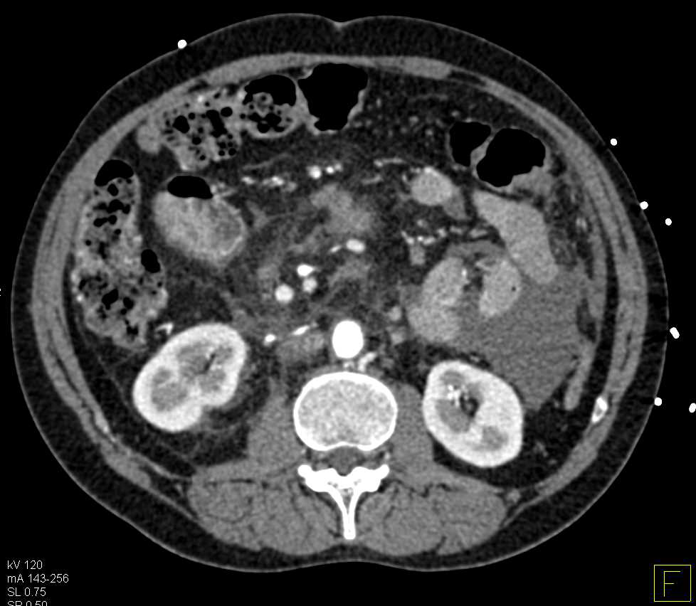 Carcinomatosis with Cavitary Lung Metastases due to Ovarian Cancer - CTisus CT Scan