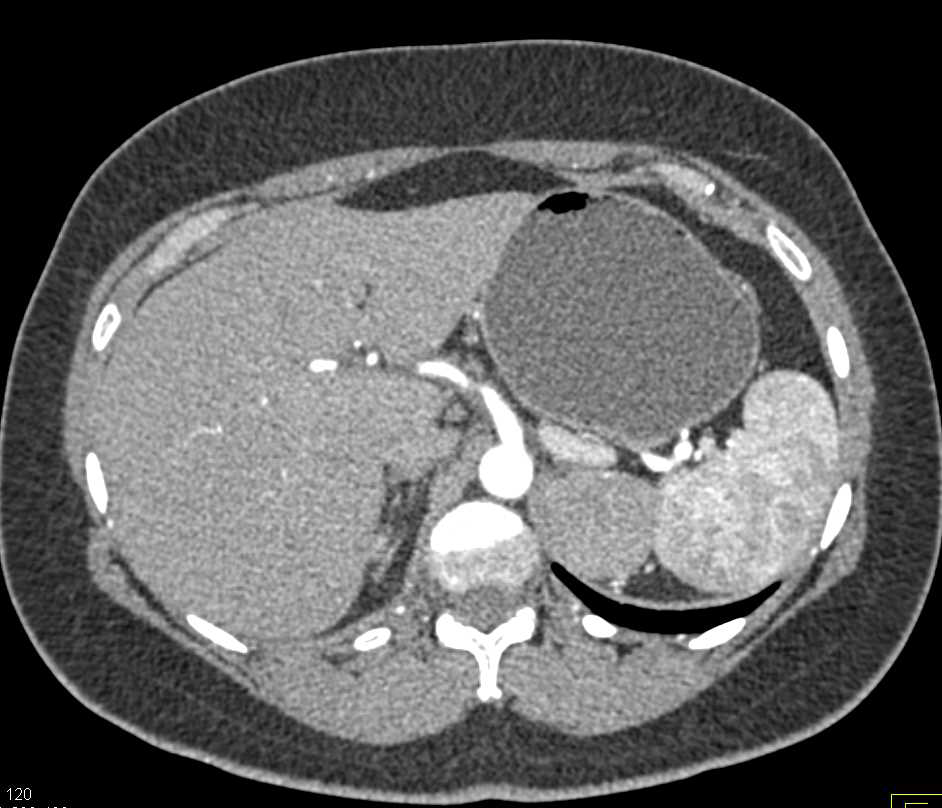 adrenal tumor on kidney