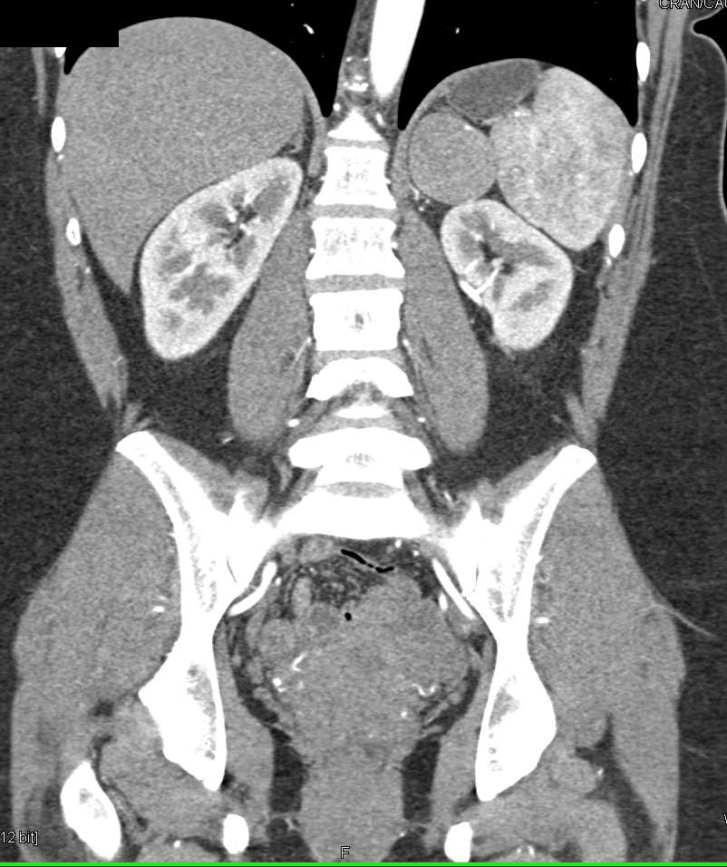 Neurogenic Tumor Left Adrenal - CTisus CT Scan