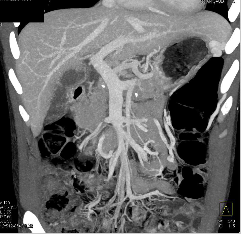 Large Left Adrenal Hematoma - CTisus CT Scan