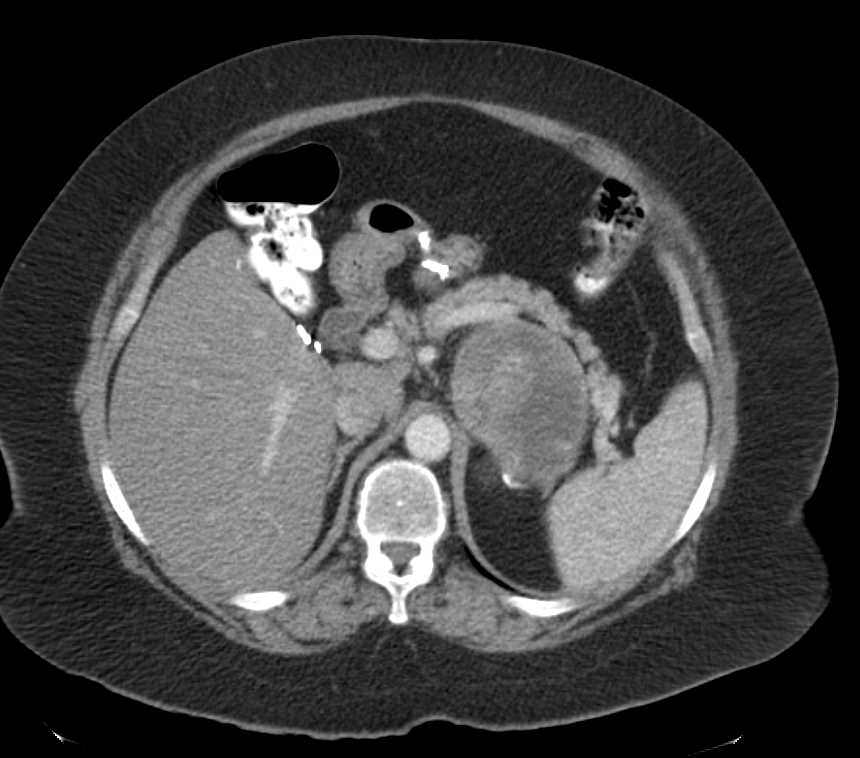 Large Left Adrenal Hematoma - CTisus CT Scan