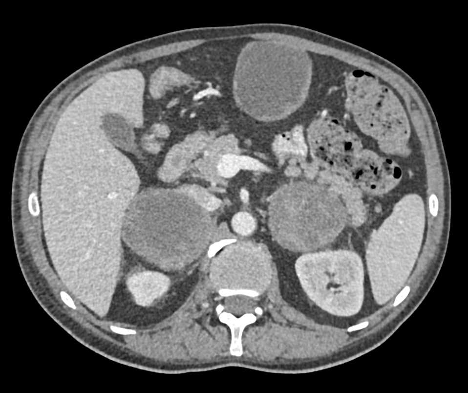 Melanoma Metastatic to Small Bowel and the Adrenal Glands - CTisus CT Scan