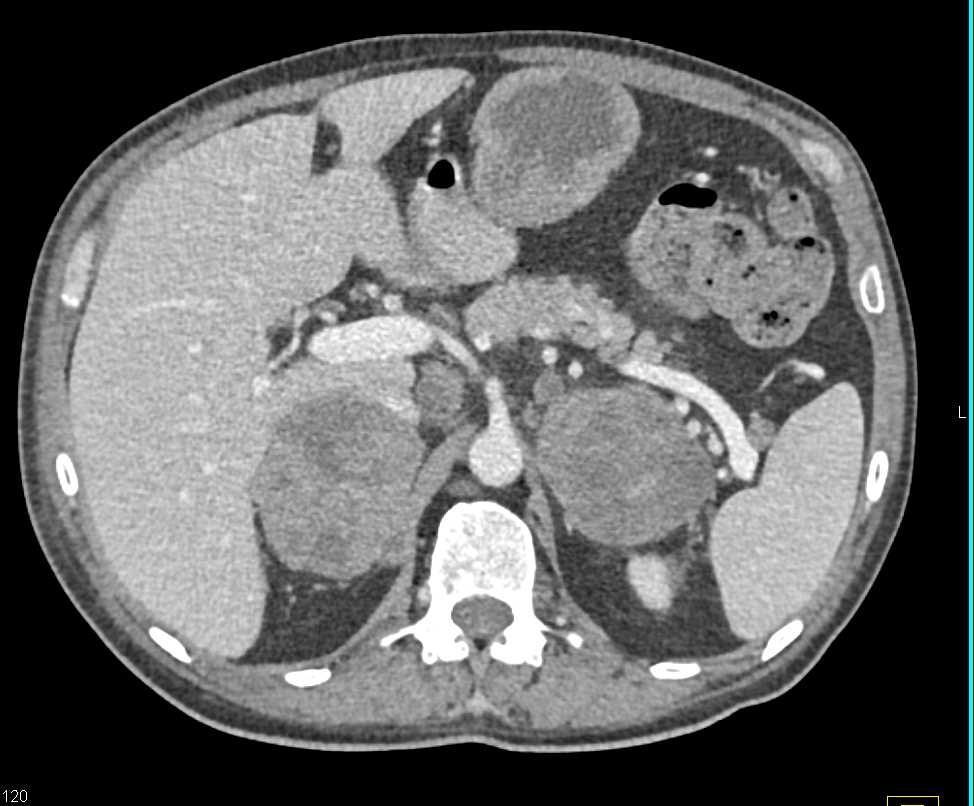 Melanoma Metastatic to Small Bowel and the Adrenal Glands - CTisus CT Scan