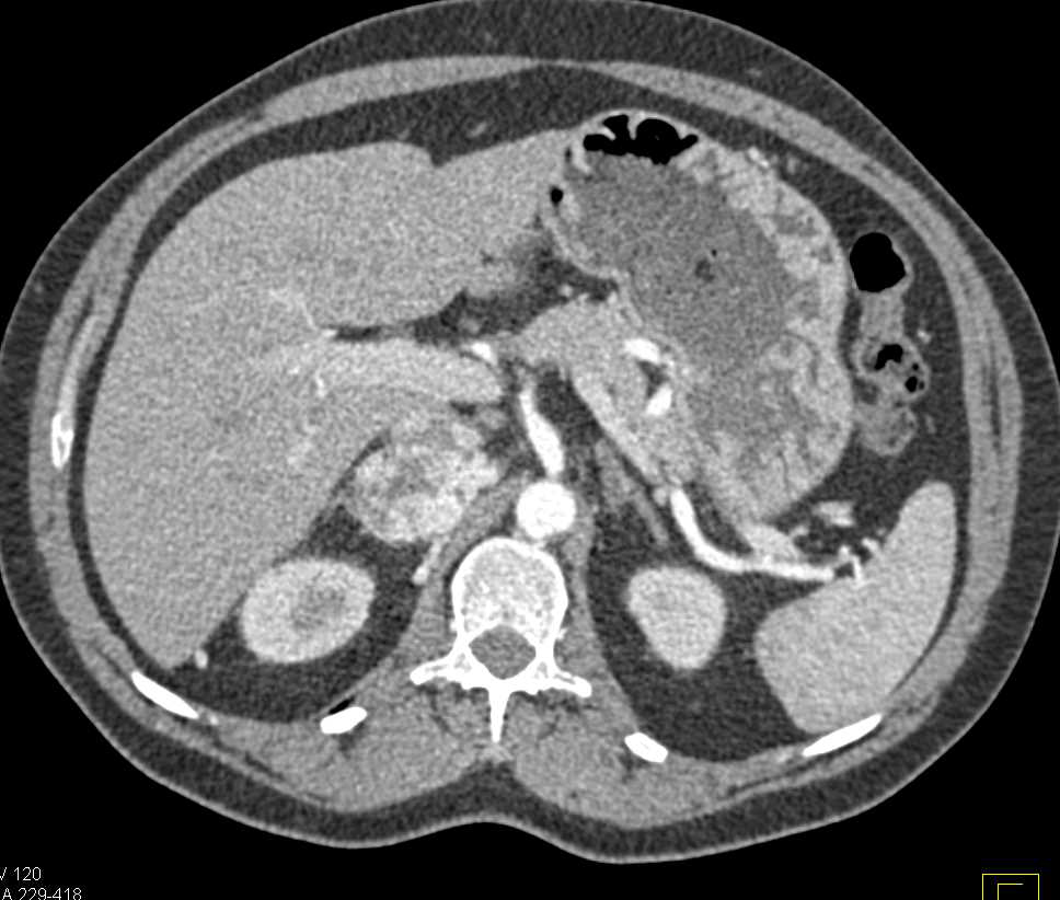 Right Adrenal Pheochromocytoma - CTisus CT Scan