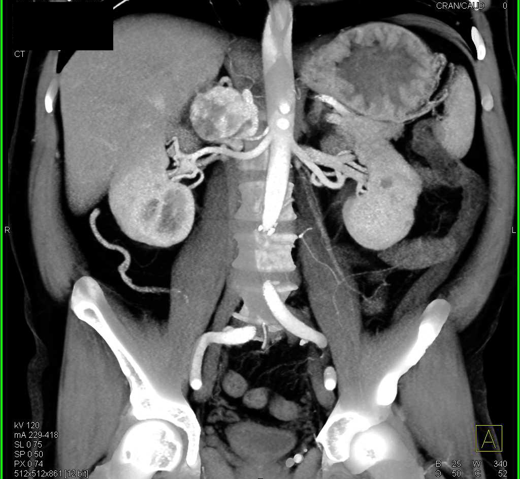 Right Adrenal Pheochromocytoma - CTisus CT Scan