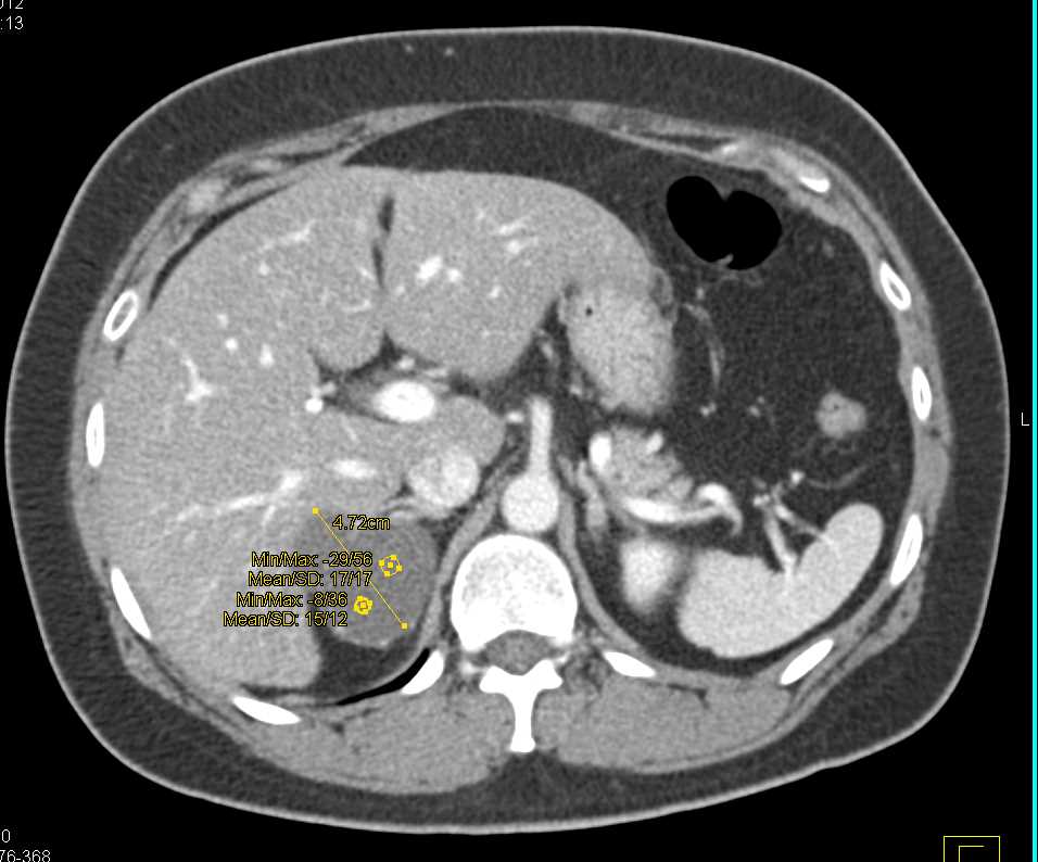 Adrenal Lymphangioma - CTisus CT Scan