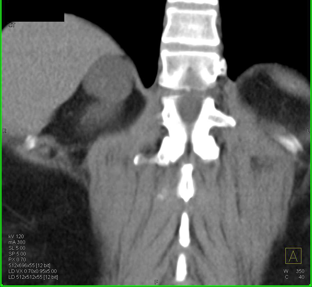 Lymphangioma - CTisus CT Scan