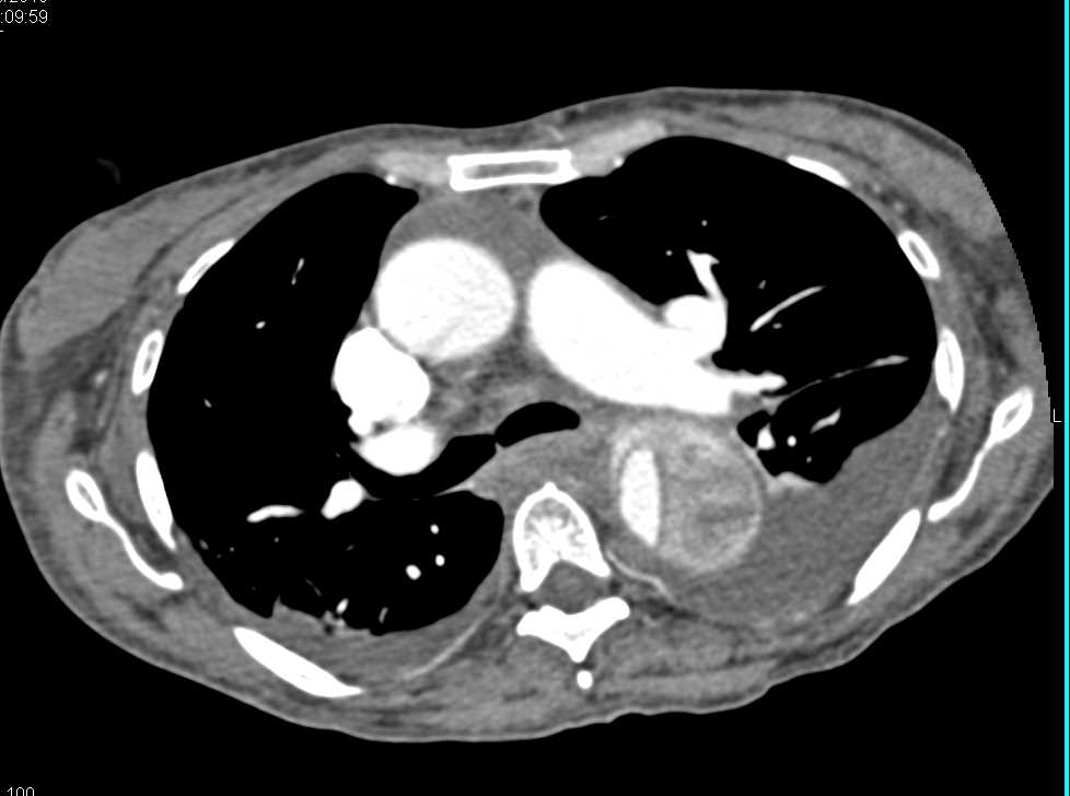 Type B dissection - CTisus CT Scan