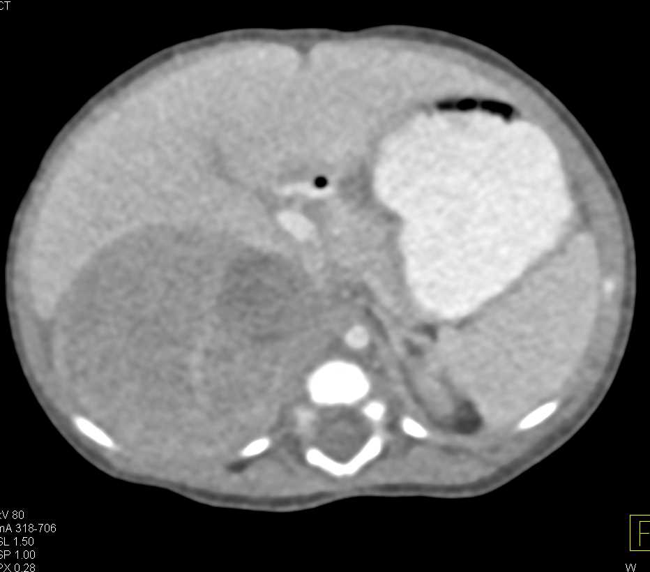 Left Adrenal Neuroblastoma - CTisus CT Scan