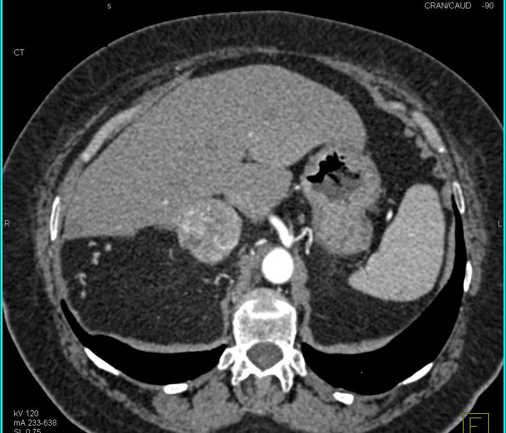 Right Adrenal Pheochromocytoma - CTisus CT Scan