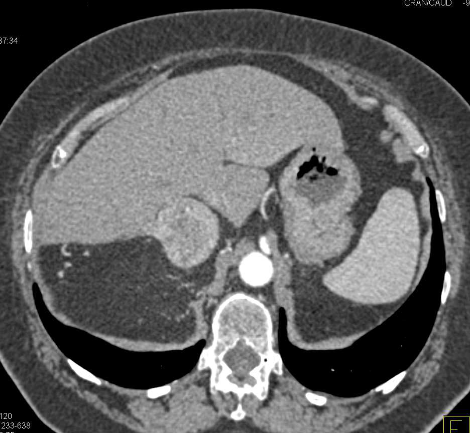 Right Adrenal Pheochromocytoma - CTisus CT Scan