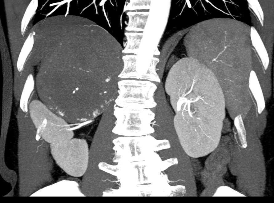 Right Adrenal Hematoma - CTisus CT Scan