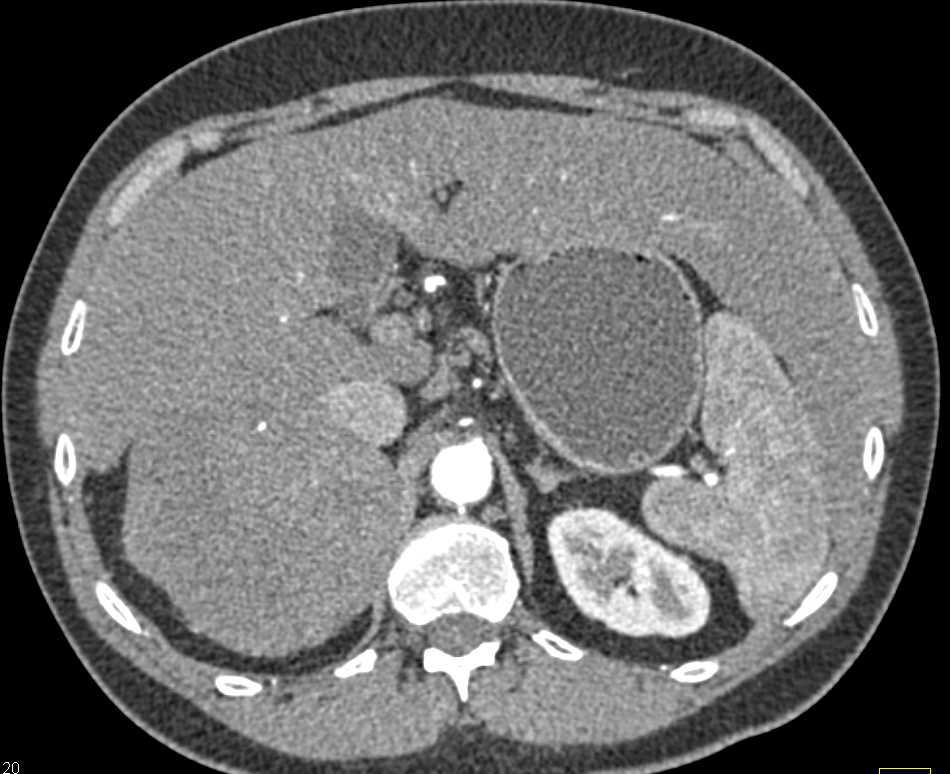 Right Adrenal Hematoma with Active Bleed - CTisus CT Scan