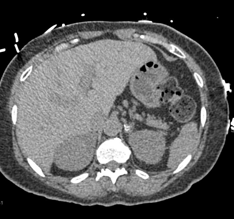 Calcified Left Adrenal Gland - CTisus CT Scan