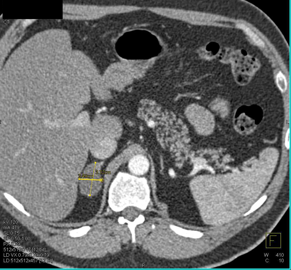 Right Adrenal Adenoma - CTisus CT Scan