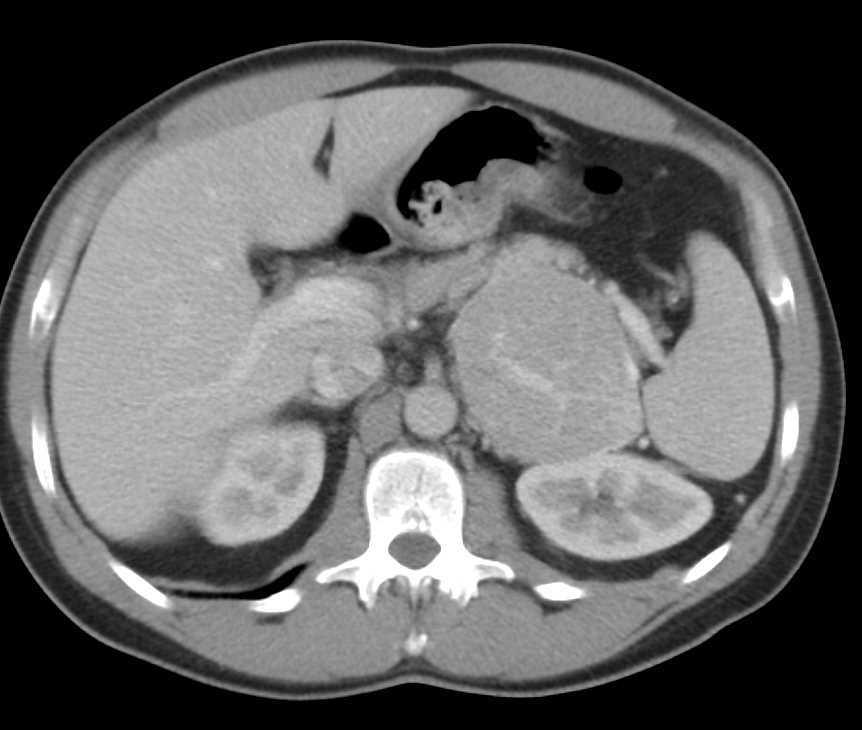 Left Adrenal Carcinoma - CTisus CT Scan