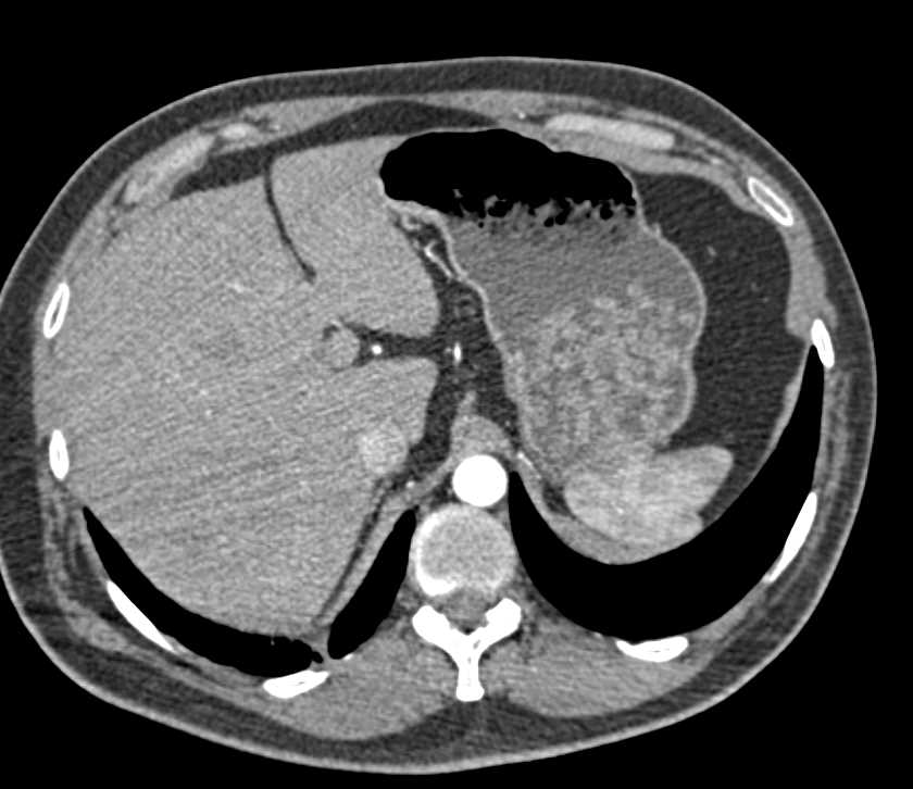 Pheochromocytoma Right Adrenal Gland - CTisus CT Scan