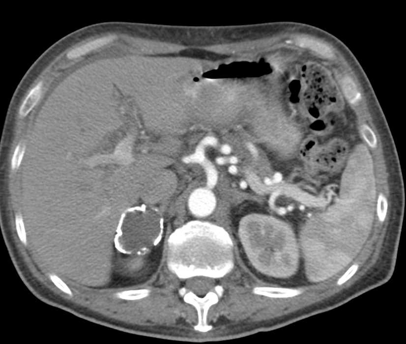 Old Calcified Adrenal Adenoma - CTisus CT Scan