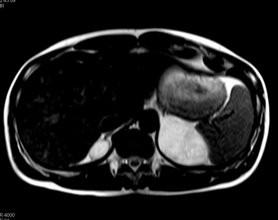 Bilateral Adrenal Myelolipomas  - CTisus CT Scan