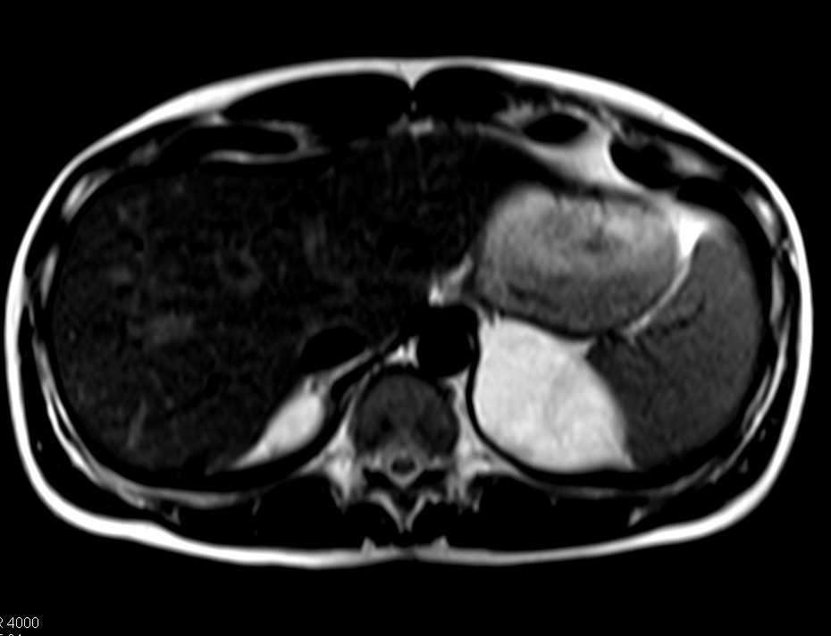 Bilateral Adrenal Myelolipomas  - CTisus CT Scan