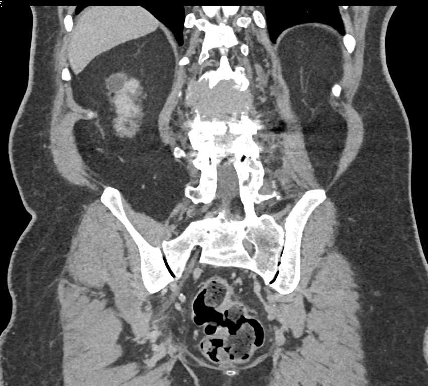 Left Adrenal Myelolipoma - CTisus CT Scan