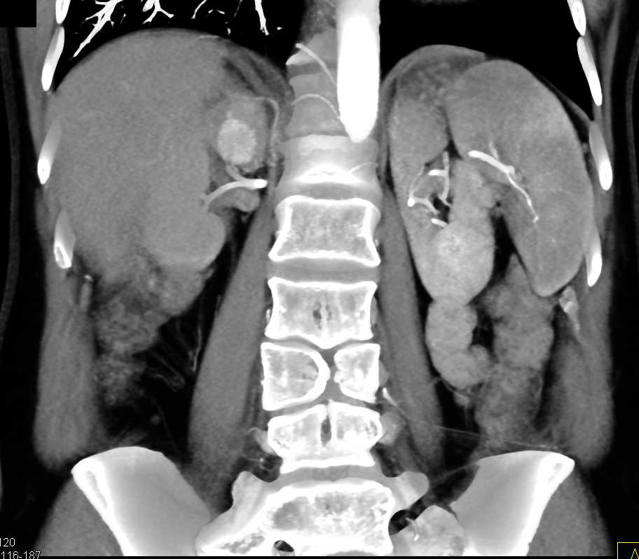 Pheochromocytoma Of The Right Adrenal Gland Adrenal Case Studies