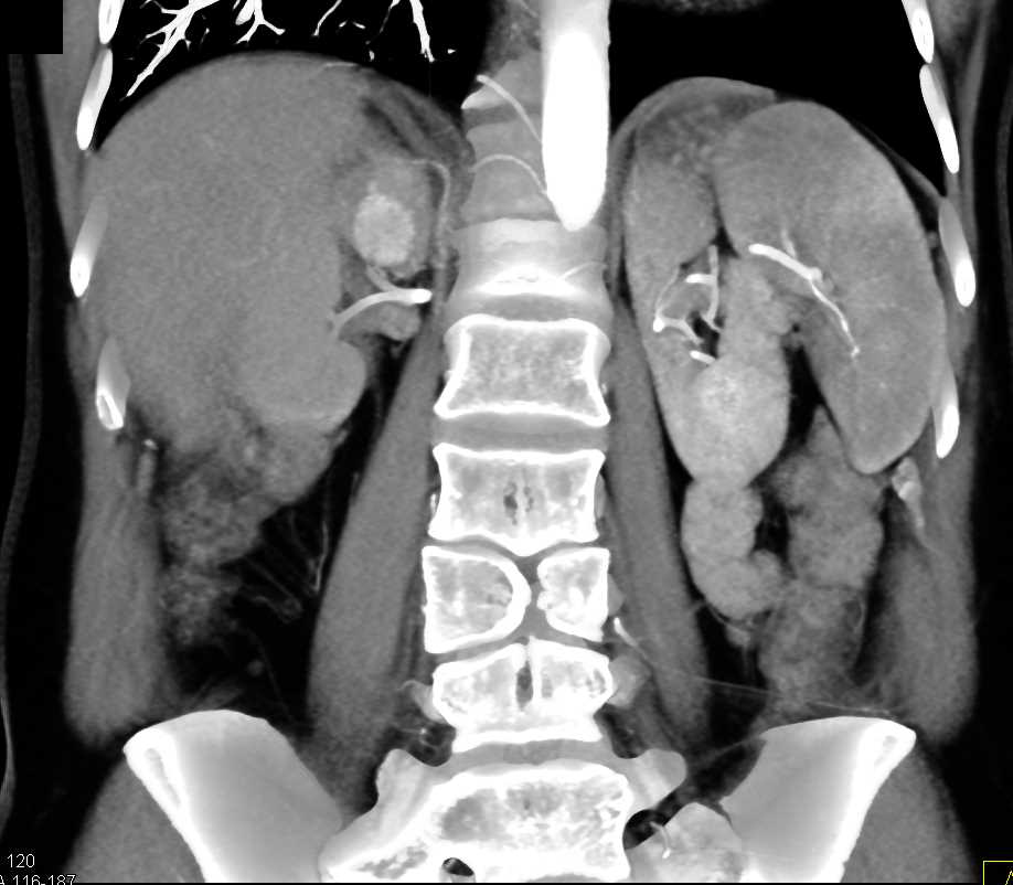 Pheochromocytoma of the Right Adrenal Gland - CTisus CT Scan