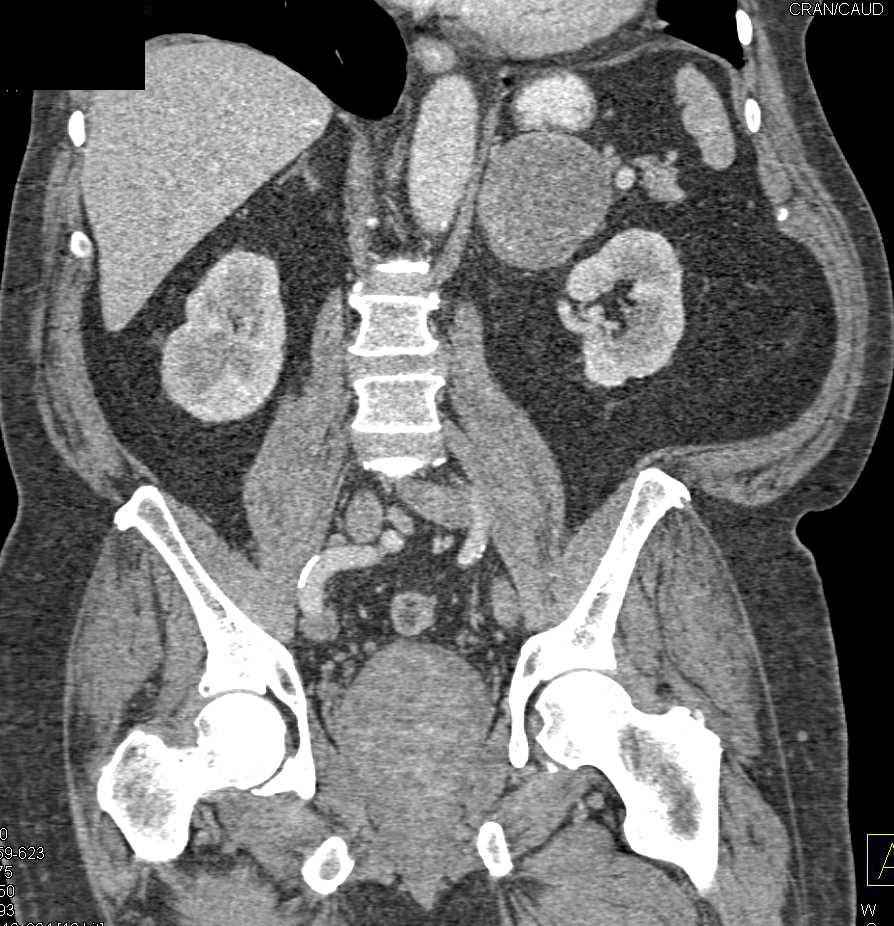 Left Adrenal Hematoma that is Chronic - CTisus CT Scan