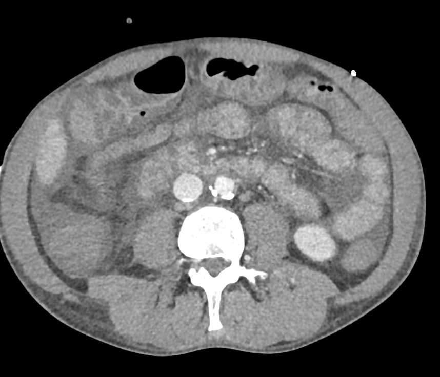 Bright Adrenal Glands Compatible With Hypotension Adrenal Case