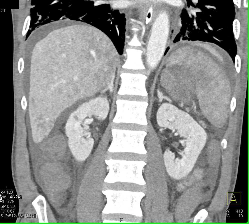 Bright Adrenal Glands Compatible With Hypotension Adrenal Case