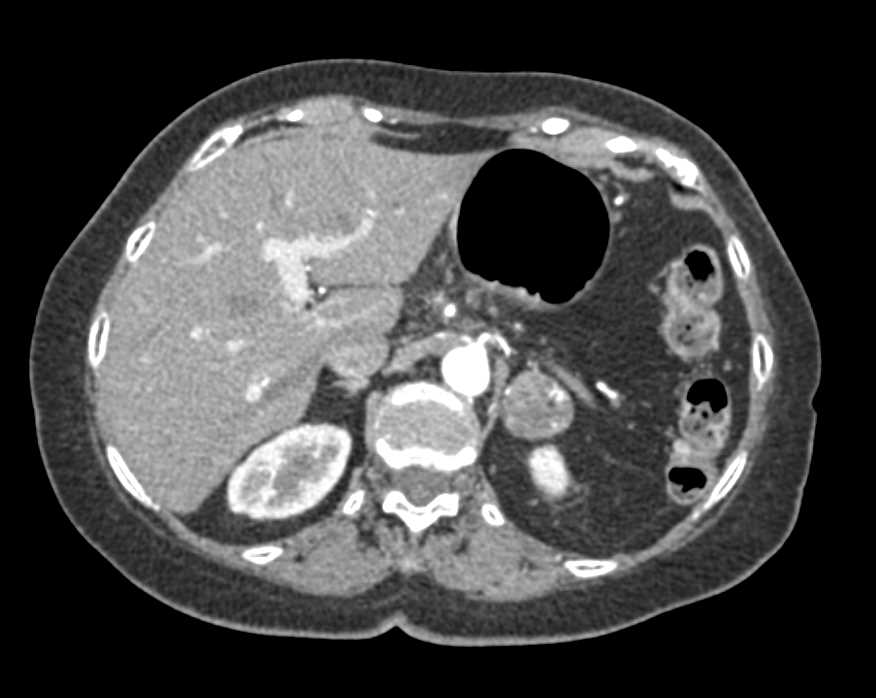 Myelolipoma Left Adrenal Gland - CTisus CT Scan