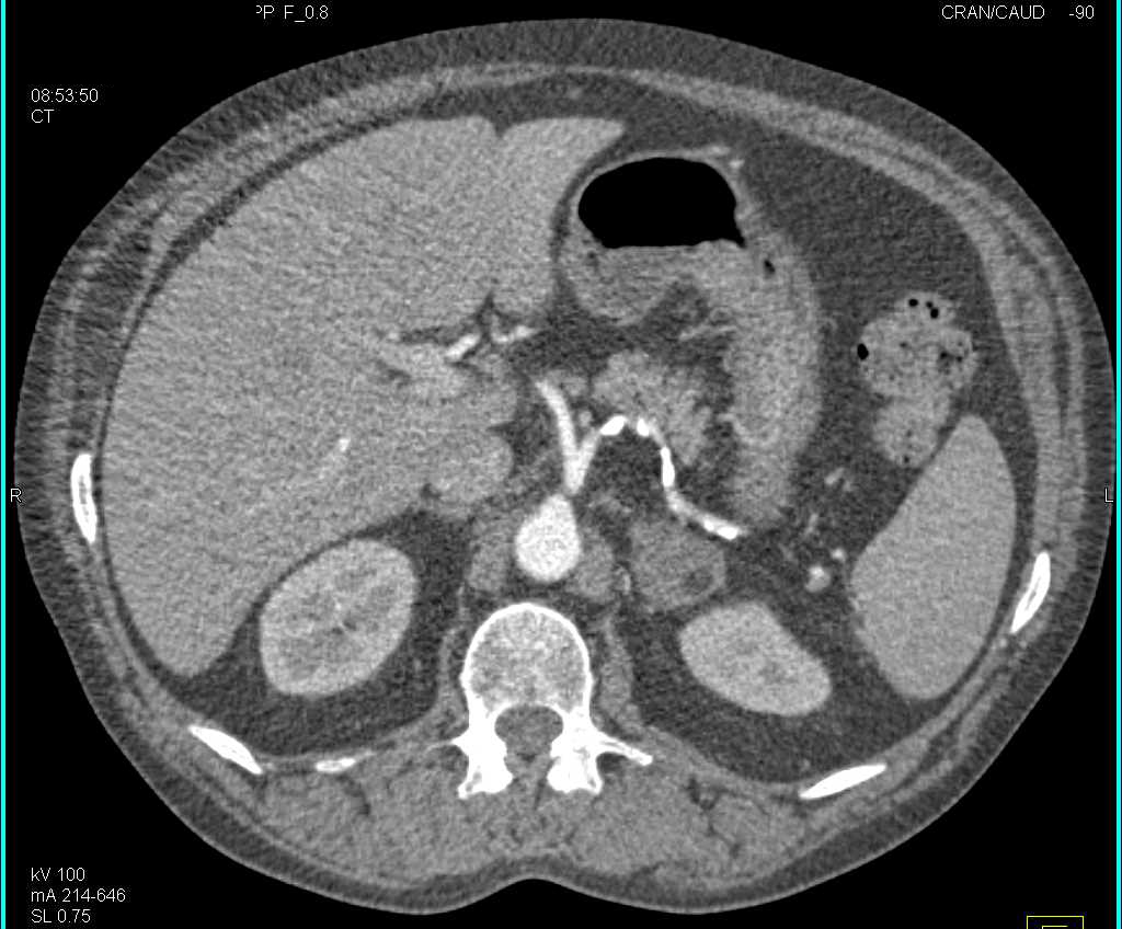 Incidental Left Adrenal Myelolipoma in a Patient with Severe Peripheral Vascular Disease (PVD) - CTisus CT Scan