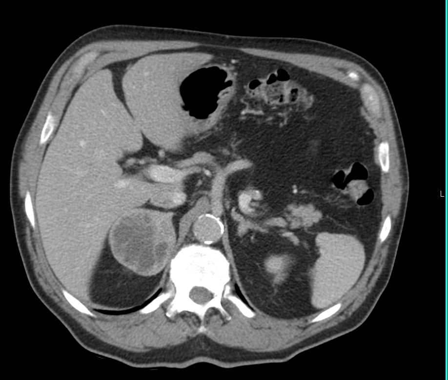 Pheochromocytoma Right Adrenal Gland - CTisus CT Scan