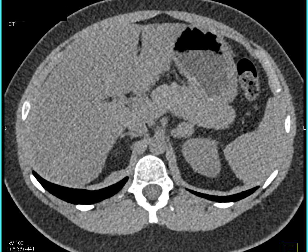 Adrenal Adenoma that Enhances to almost 90HU - CTisus CT Scan