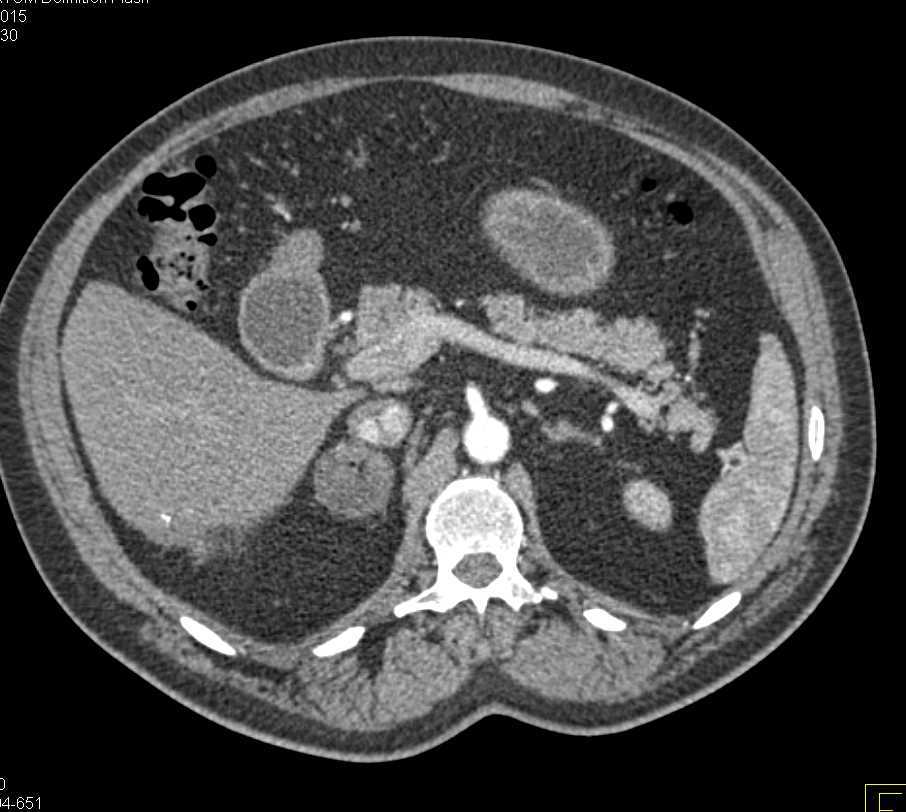 Myelolipoma Right Adrenal Gland - CTisus CT Scan