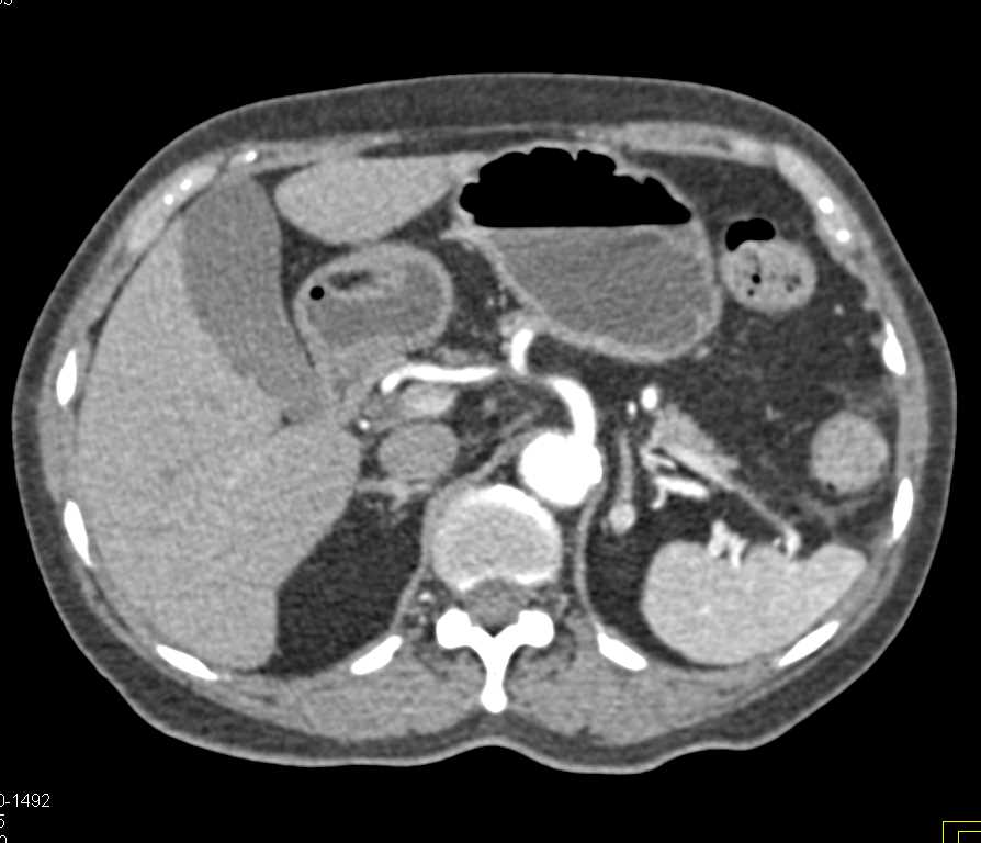 1 cm Pheochromocytoma Left Adrenal Gland - CTisus CT Scan