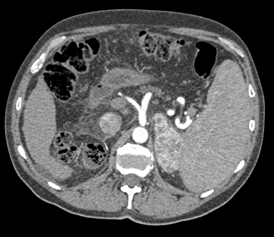 Renal Cell Carcinoma Metastatic to the Left Adrenal - CTisus CT Scan