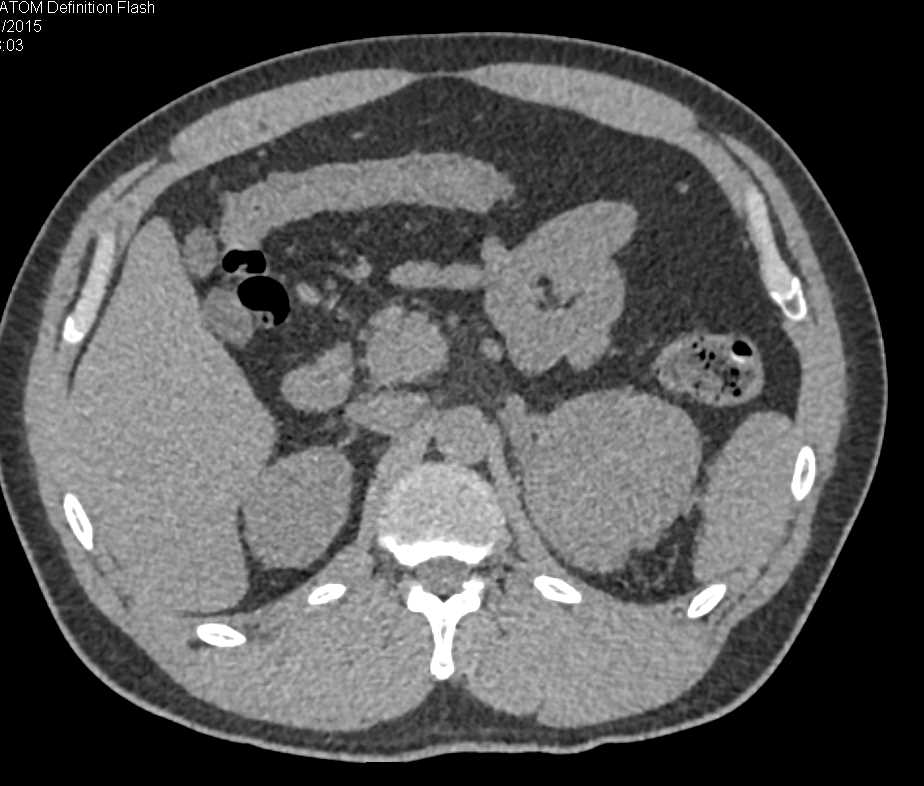 Primary Adrenal Carcinoma - CTisus CT Scan