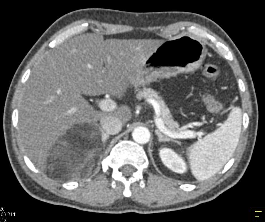 Myelolipoma Right Adrenal Gland - CTisus CT Scan