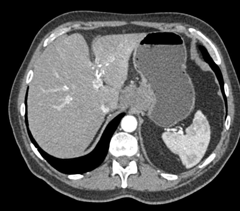 Lymphoma with Extensive Adenopathy - CTisus CT Scan