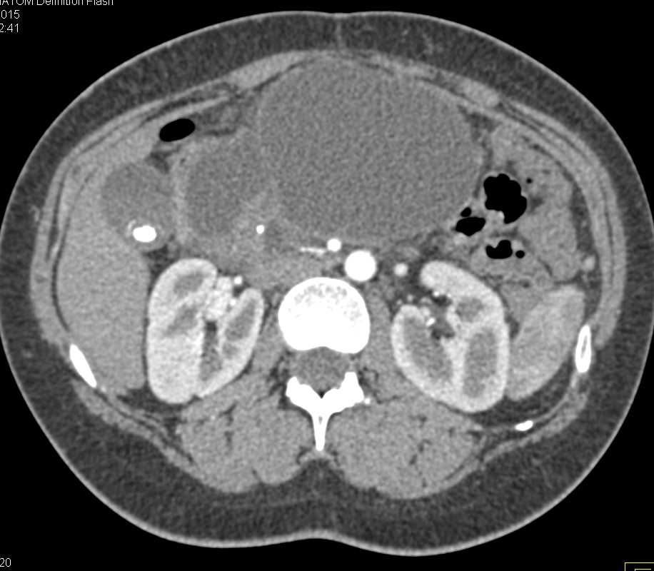 Large Bilobed Pseudocysts of the Pancreas - CTisus CT Scan