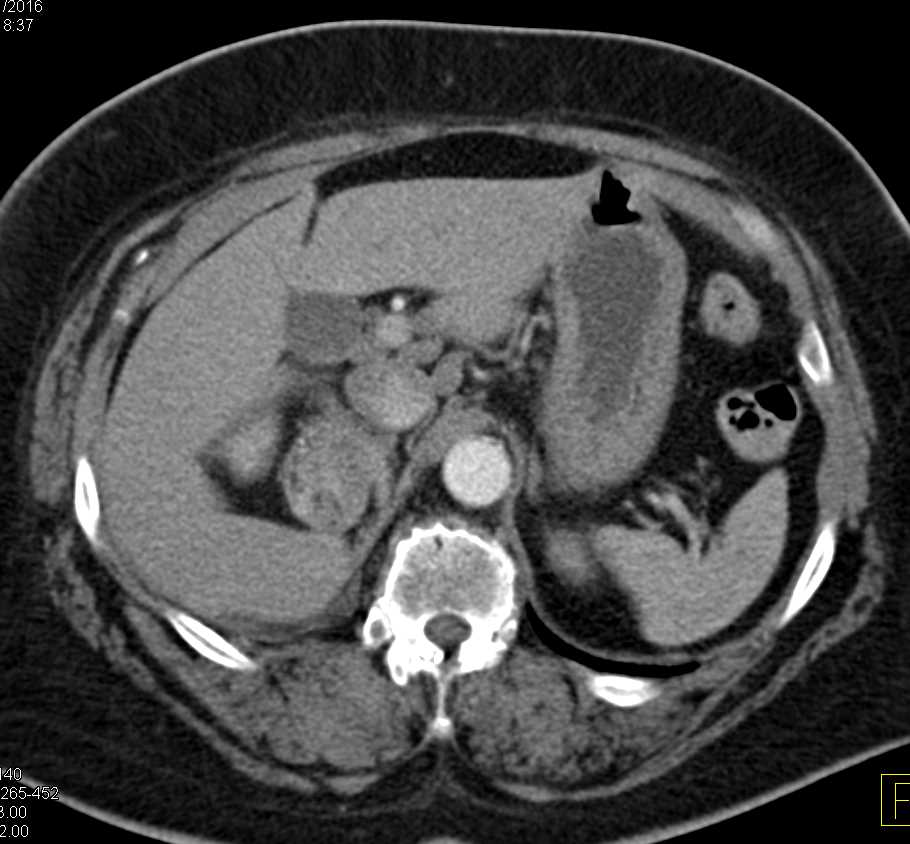 Myelolipoma Right Adrenal Gland - CTisus CT Scan